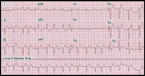 ECG Interpretation: ECG Interpretation Review #31 (A Fib – RBBB – LBBB – IVCD – LAD – Infarct ...