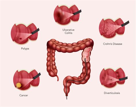 Colonoscopy - CVSKL