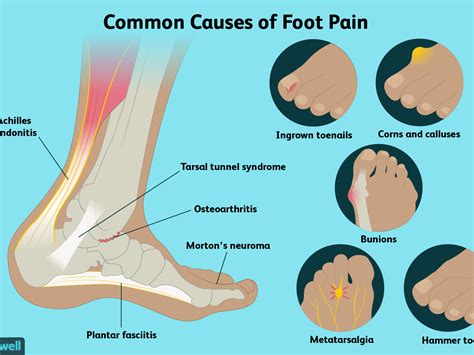 Top Foot Pain Diagnosis Chart - Best Picture Of Chart Anyimage.Org