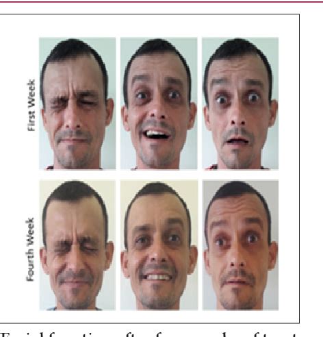 Figure 1 from Treatment of Bell Palsy using Facial Exercises in Primary ...