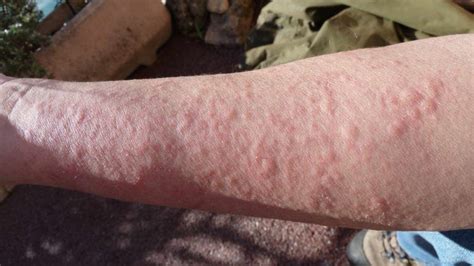 What Does it Mean if You Have These Rashes? | TipHero