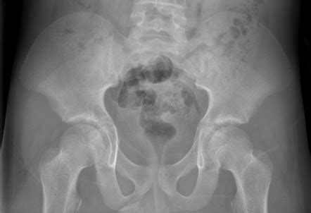 Pelvis (AP view) | Radiology Reference Article | Radiopaedia.org