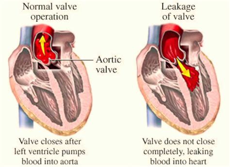 Aortic Valve Regurgitation - Causes, Symptoms, Treatment