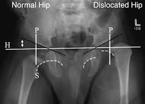 Hip dysplasia normal hip xray - sergapplication