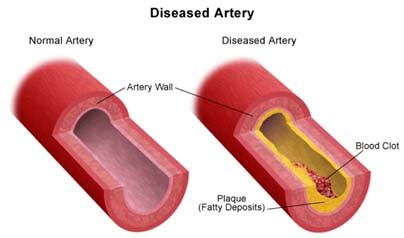 Surgery India Carotid Artery Stenosis,Cost Carotid Artery-Stenosis