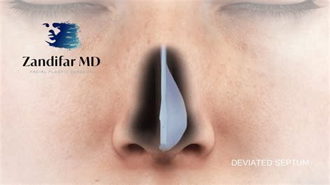 What are the signs You May Have A Deviated Septum - Zandifar MD