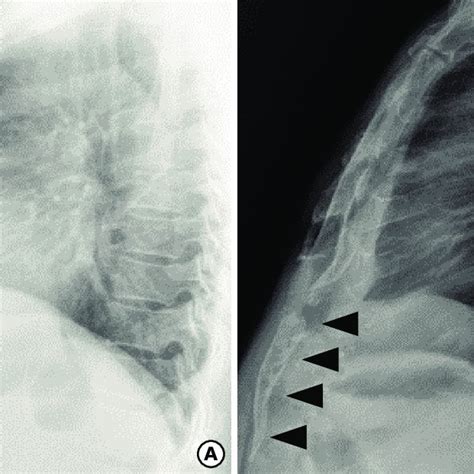 (PDF) Heterotopic Ossification of the Xiphoid Process after Abdominal Surgery for Traumatic ...