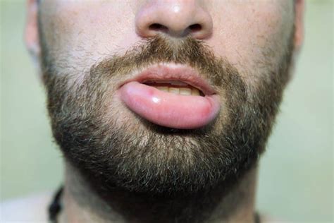 What Allergy Causes Swollen Lips - Infoupdate.org