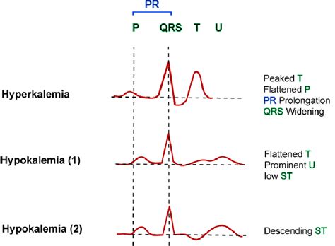 Hypokalemia Hyperkalemia Ecg