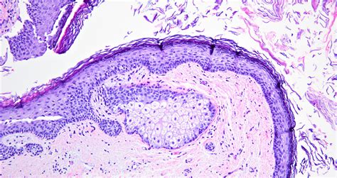 Pilar Cyst Histology