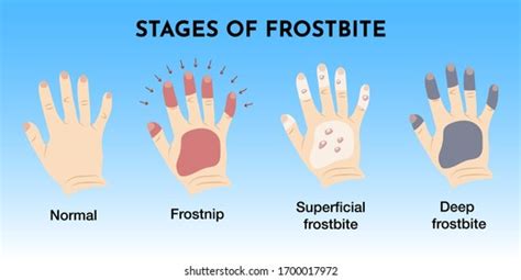 Frostbite Stock Photos - 6,058 Images | Shutterstock