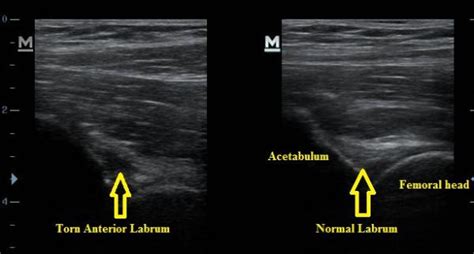 Hip Ultrasound