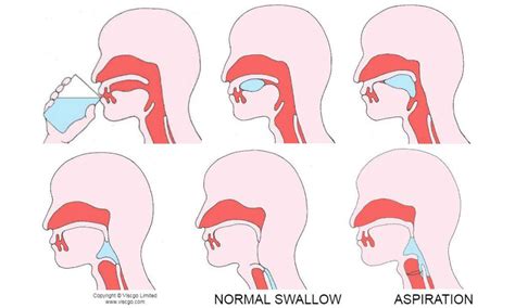 What Is Dysphagia? - Viscgo