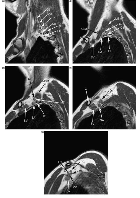 Figure 1 from MRI of the brachial plexus: a pictorial review. | Semantic Scholar