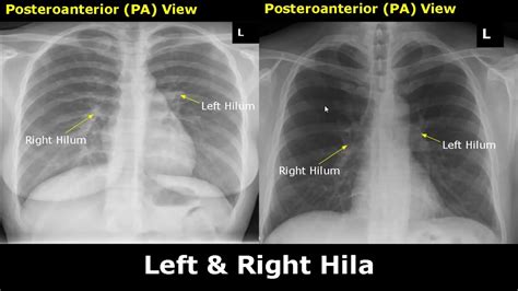 Normal Chest X Ray Labeled