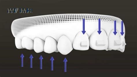 Invisalign Attachments: What are they and how do they work? - WOMS