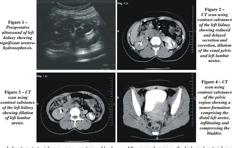 Bladder Endometriosis Mri / Urinary Tract Endometriosis Has Serious ...