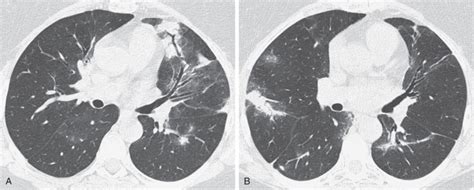 Cryptogenic Organizing Pneumonia/Secondary Organizing Pneumonia | Radiology Key