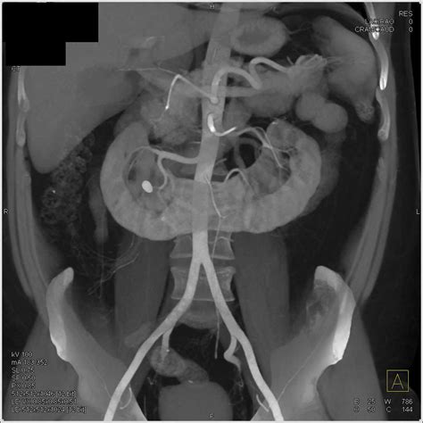 Horseshoe Kidney with Calculus but Normal Function - Kidney Case Studies - CTisus CT Scanning