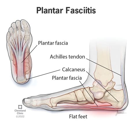 Plantar Fasciitis Causes And Treatment on Sale | bellvalefarms.com