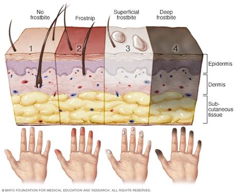 Stages of frostbite - Mayo Clinic