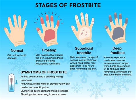 Frostbite symptoms: How cold does it need to be to get it and how fast ...