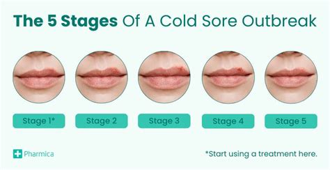 Cold Sore Stage 2