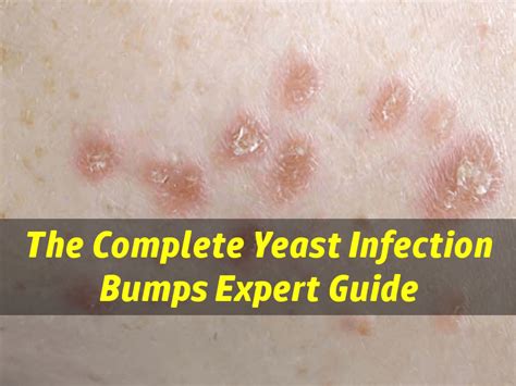 Yeast Fungal Skin Infection : Skin infection pictures and treatments / Sometimes, under certain ...