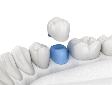 Astoria Dentist Looks At How A Crown Repairs A Tooth | Astoria, NY