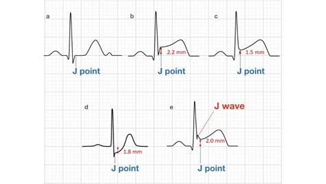 STEMI (ST Elevation Myocardial Infarction): Diagnosis,, 46% OFF