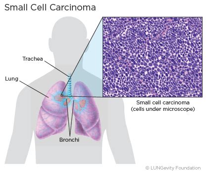 Small Cell Lung Cancer (SCLC) | LUNGevity Foundation