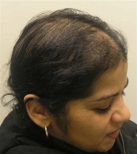 androgenic alopecia treatment - pictures, photos