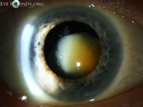 Morgagnian cataract with absent cortex