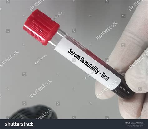 Blood Sample Serum Osmolality Test Helps Stock Photo 2224600807 | Shutterstock