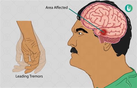 Hand Tremors: symptoms, causes, treatment, medicine, prevention, diagnosis