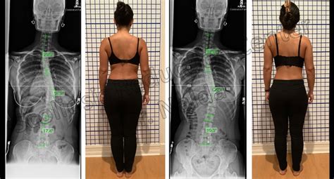 Scoliosis Treatment Results - See Before and After Pictures