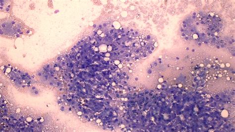 Hepatic Lipidosis Histology