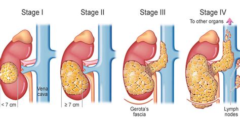 Stages of Kidney Cancer Treatment - Dr. Irfan Shaikh | Urolife Clinic, Pune