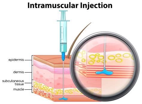 Human Skin Intramuscular Injection 433484 Vector Art at Vecteezy