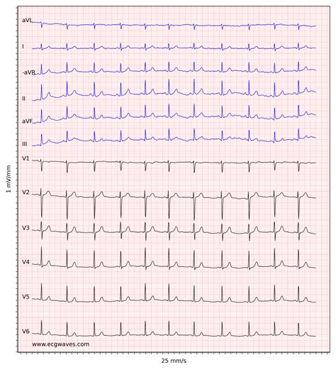 ECG interpretation: Characteristics of the normal ECG (P-wave, QRS complex, ST segment, T-wave ...