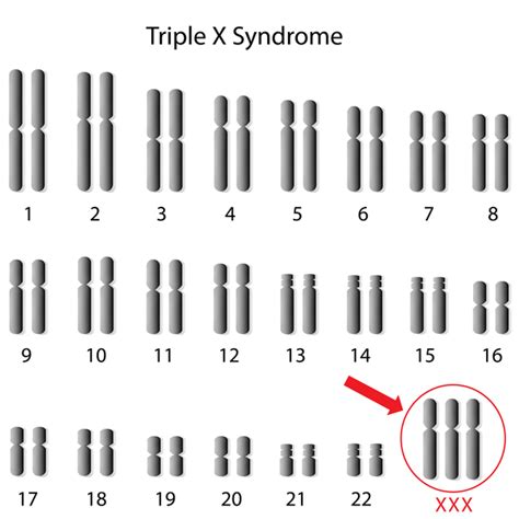 Trisomy X: MedlinePlus Genetics