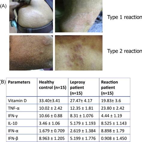 (A) Skin lesions in typical type 1 and type 2 reactions among leprosy... | Download Scientific ...