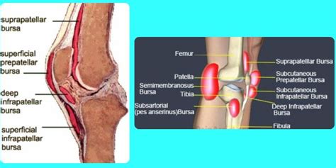 Bursitis Knee - Treatment, Pictures, Symptoms,Causes, Diagnosis