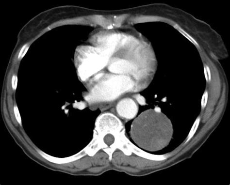 Pulmonary Hamartoma | Consultant360