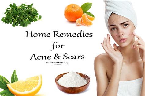 Effective Home Remedies For Acne & Scars - Heart Bows & Makeup