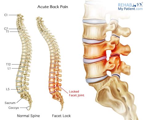 Acute Back Pain | Rehab My Patient