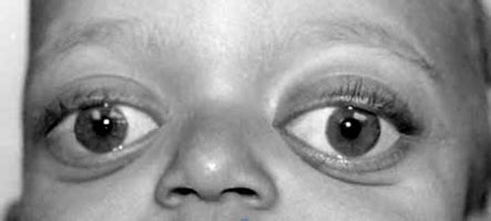 Antimongoloid slanting palpebral fissures | Rare Care World