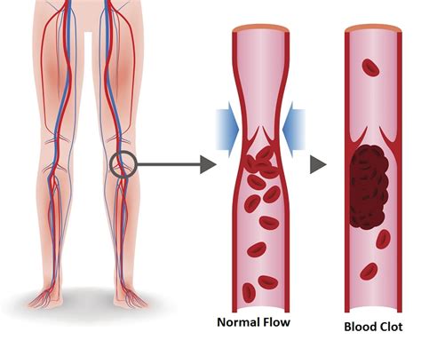 Signs and Symptoms Of A Blood Clot - Health BeatHealth Beat