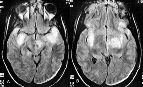 Conjugate eye deviation due to traumatic striatal-subthalamic lesion - Journal of Clinical ...