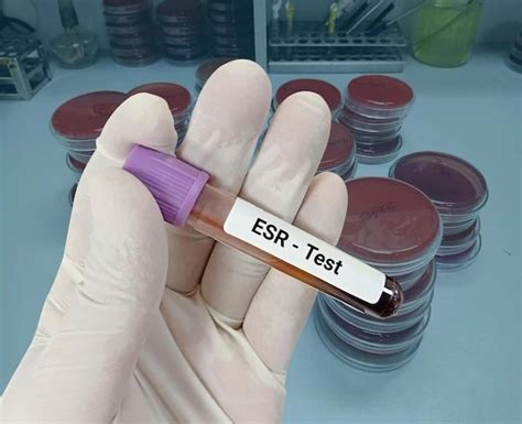 ESR (Erythrocyte Sedimentation Rate) – Diagnostic Plus